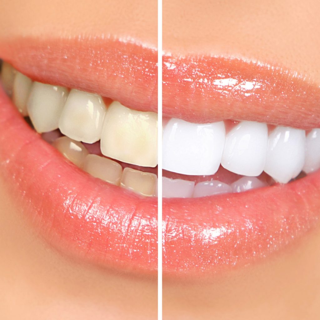 teeth whitening adamsville